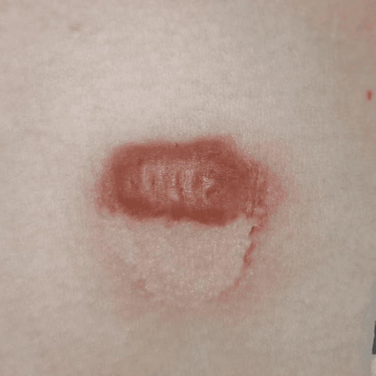 Before treatment